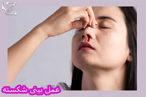 عمل بینی شکسته