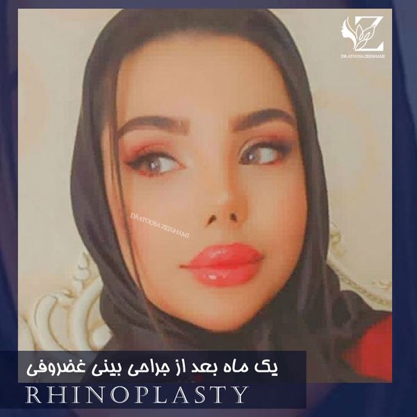 عمل بینی فاطمه حسینی - https://dr-zeighami.com/