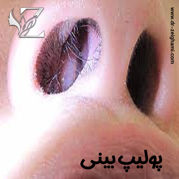 پولیپ بینی - دکتر آتوسا ضیغمی