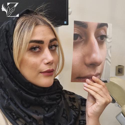 جراحی-بینی-940