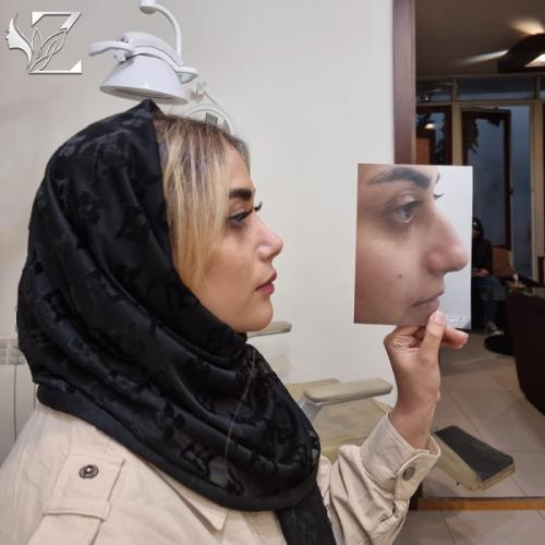 جراحی-بینی-943