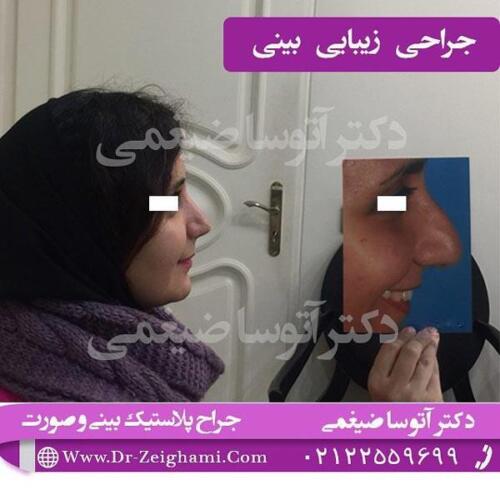 عمل-بینی-135