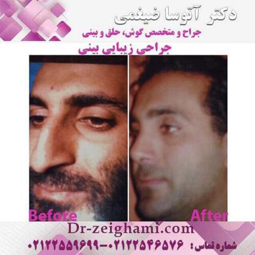 عمل-بینی-150