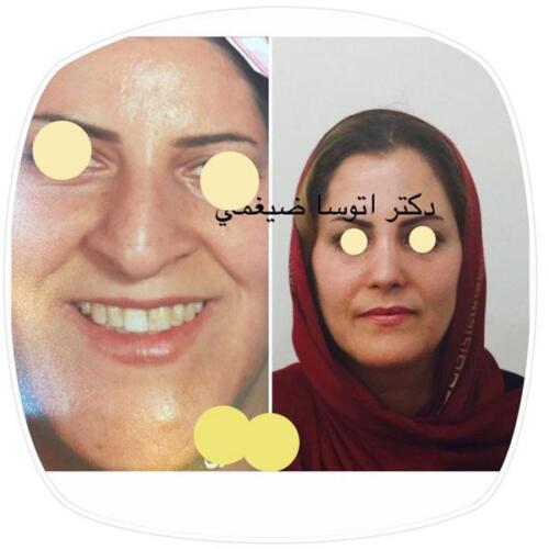 عمل-بینی-155