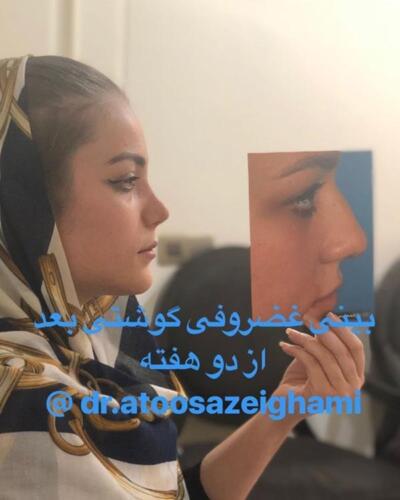 عمل-بینی-228