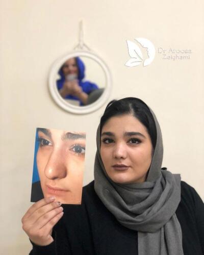 عمل-بینی-500