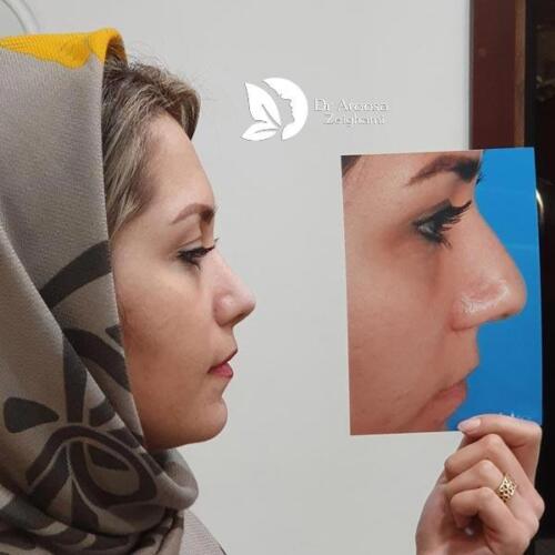 عمل-بینی-560