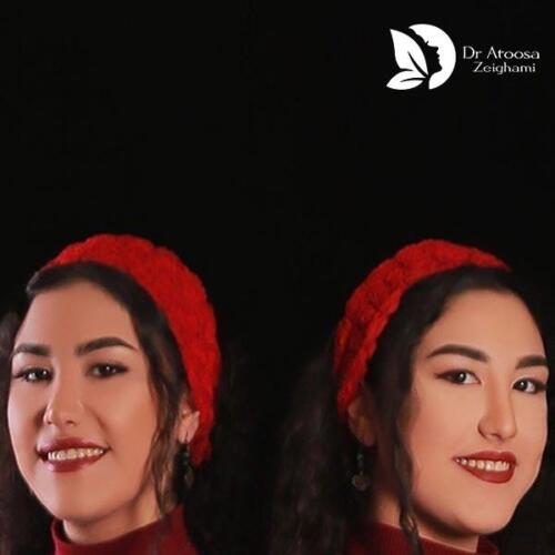 عمل-بینی-605