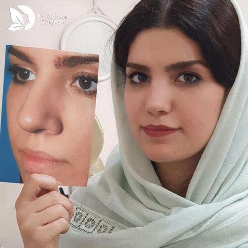 عمل-بینی-615