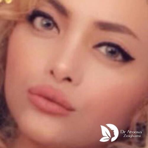 عمل-بینی-645