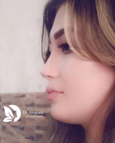 عمل-بینی-718