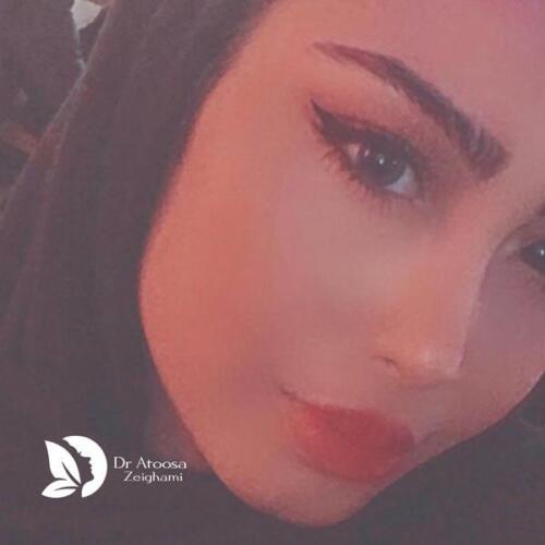 عمل-بینی-742